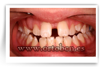 dents separats